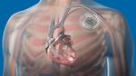 Real Time Heart Model for Implantable Cardiac Device Validation and Verification