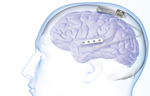 Adaptive Deep Brain Stimulation